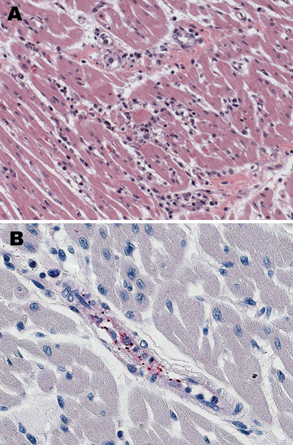 Histologic and immunohistochemical evaluation of heart tissue. A) Lymphohistiocytic inflammatory cell infiltrates in the myocardium (hematoxylin and eosin stain; original magnification ×25). B) Immunohistochemical detection of spotted fever group rickettsiae (red) in perivascular infiltrates of heart (immunoalkaline phosphatase with naphthol-fast red substrate and hematoxylin counterstain; original magnification ×250.