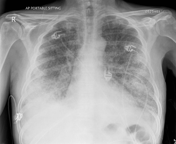 Chest radiograph of patient 11 at time of admission to hospital, before intubation, demonstrating extensive bilateral airspace disease.