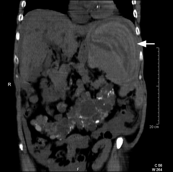 Coronal view of unenhanced abdominal computed tomography demonstrating splenic enlargement with endocapsular hematoma and intraperitoneal hemorrhage (arrows).