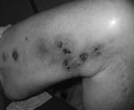 Thumbnail of Nodular-ulcerative skin lesions on the left thigh caused by Mycobacterium haemophilum infection in a patient with chronic lymphocytic leukemia (patient 1) whose condition had been treated with alemtuzumab.