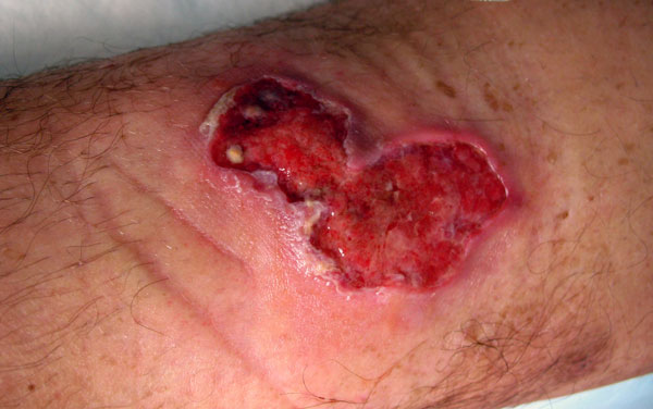 Ulcer (3 × 6 cm) on anterior side of the left leg of the patient, showing an erythematous border.