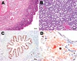 Thumbnail of A) Sheep placenta positive by real-time PCR and immunohistochemistry for Parachlamydia spp. and Chlamydiaceae. Chlamydophila abortus was identified by ArrayTube Microarray. Necrotizing placentitis and vasculitis are shown (hematoxylin and eosin stain; magnification ×200). B) Fetal lung of the sheep abortion specimen positive by real-time PCR and immunohistochemical tests for Parachlamydia spp. and Chlamydiaceae; interstitial pneumonia is shown (hematoxylin and eosin stain; magnification ×200). C) Fetal lung that was positive by real-time PCR and immunohistochemical testing for Parachlamydia spp. Positive granular material can be seen within the lung tissue. Antigen detection (immunohistochemistry) was carried out with a polyclonal antibody directed against Parachlamydia spp. 3-amino-9-ethylcarbazole/peroxidase method (hematoxylin counterstain; magnification ×200). D) Double immunohistochemical labeling of the sheep placenta that was positive by real-time PCR and immunohistochemical tests for Chlamydiaceae and Parachlamydia spp. The simultaneous presence of Chlamydiaceae and Parachlamydia spp. granular reaction is shown within necrotic trophoblastic epithelium and neutrophilic exudate (diaminobenzidine/AEC/peroxidase method, hematoxylin counterstain; magnification ×1,000).