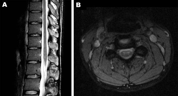 A) Sagittal image of the conus and B) coronal image of the cervical cord, demonstrating increased signal on T2 weighted sequences in the region of the anterior horns. There was no enhancement with contrast.