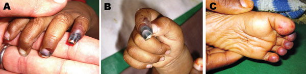 Digital gangrene in an 8-month-old girl during week 3 of hospitalization. She was admitted to the hospital with fever, multiple seizures, and a widespread rash; chikungunya virus was detected in her plasma. A) Little finger of the left hand; B) index finger of the right hand; and C) 4 toes on the right foot.