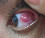 Thumbnail of Conjunctival infection and opaque scleral nodule with vascularization in case-patient with confirmed ocular disease, Araguatins, Brazil. Source: Dr Leandro Alencar/Dr Carlos Franklin.
