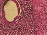 Thumbnail of Scleral nodule biopsy specimen, showing diffuse, subconjunctival mixed-cellular infiltrate surrounding large, thick-walled adiaconidia of Emmonsia sp. (magnification ×200, hematoxylin and eosin stain), Araguatins, Brazil. Source: Department of Pathology, University of Brasília.