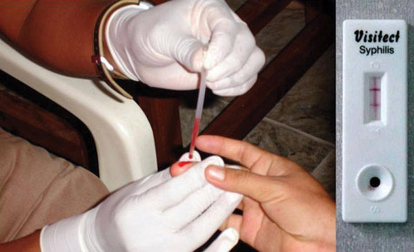 Rapid point-of-care syphilis test. Finger prick (left); diagnostic cassette with test bands results (right).