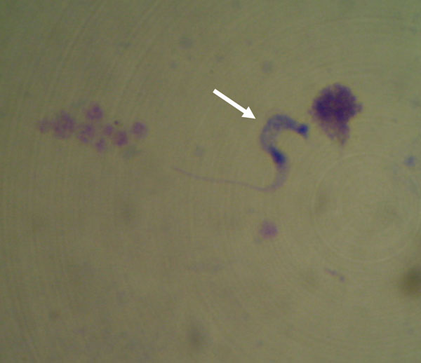 Trypanosoma cruzi (arrow) in a peripheral blood smear of a patient at a local health facility in a rural area of Pará State, Brazil (Giemsa stain, magnification ×100). Image provided by Adriana A. Oliveira, Brazilian Field Epidemiology Training Program, Brasilia, Brazil.