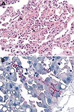 Thumbnail of Liver biopsy specimen from patient 2 showing focal hepatocyte necrosis (arrows) without prominent inflammatory cell infiltrates (A) and Lujo virus antigens (red) distributed predominantly in a membranous pattern around infected hepatocytes (B). Hematoxylin and eosin staining in panel A and immunoalkaline phosphatase staining with naphthol fast-red stain and monoclonal antibody against GP2 Lassa virus diluted 1:1,000 in panel B. Original magnifications ×50 (A) and ×100 (B).