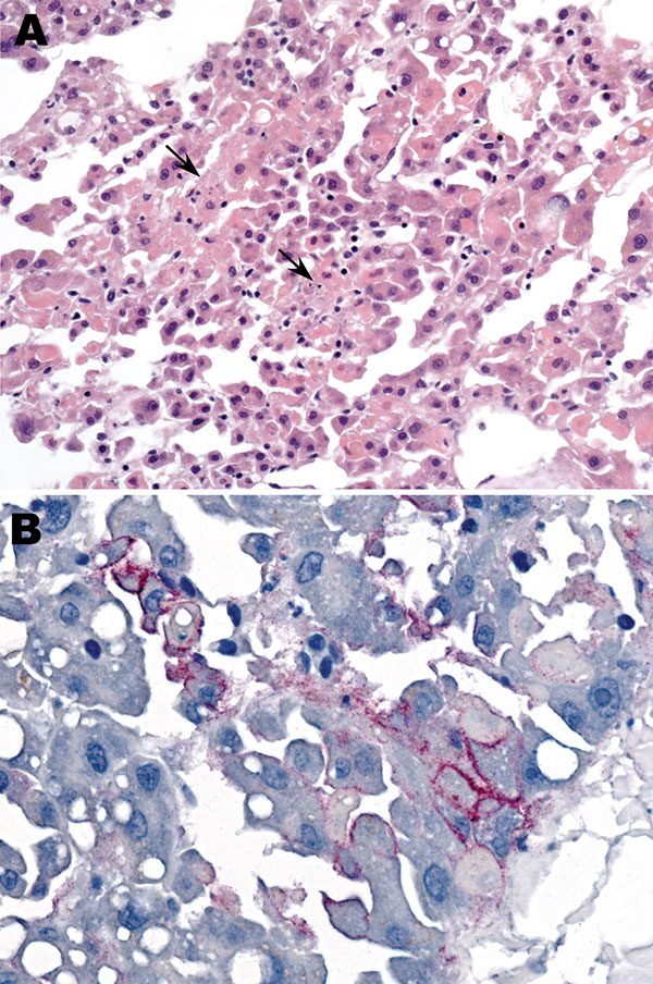 Liver biopsy specimen from patient 2 showing focal hepatocyte necrosis (arrows) without prominent inflammatory cell infiltrates (A) and Lujo virus antigens (red) distributed predominantly in a membranous pattern around infected hepatocytes (B). Hematoxylin and eosin staining in panel A and immunoalkaline phosphatase staining with naphthol fast-red stain and monoclonal antibody against GP2 Lassa virus diluted 1:1,000 in panel B. Original magnifications ×50 (A) and ×100 (B).