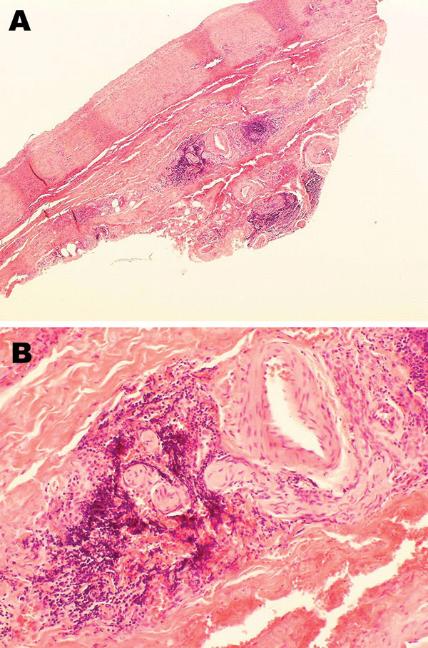Histopathologic appearance of abdominal aortic biopsy sample from 35-year-old mink farmer in Denmark who had been exposed to Aleutian mink disease parvovirus−infected mink for 10 years (patient 1). A) Perivascular, adventitial lymphoplasmacytoid infiltration. Original magnification ×4. B) Minimal atherosclerotic changes. Original magnification ×20.
