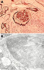 Thumbnail of Histopathologic appearance of renal biopsy sample from 54-year-old mink farmer in Denmark who had been exposed to Aleutian mink disease parvovirus−infected mink for 34 years (patient 2). A) Glomeruli with hypercellularity and crescents. Original magnification ×20. B) Electron microscopy showing distinct extracellular deposits of coarse 20-nm fibrils (microtubular structures) characterized as immunotactoid glomerulopathy. Original magnification ×100,000.