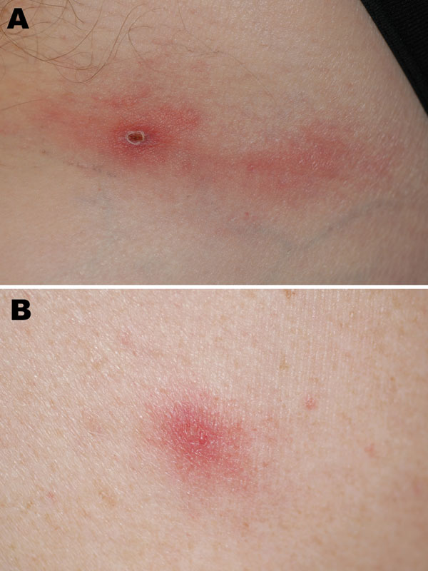 Inoculation eschar on left inguinal fold (A) and vesicular skin lesion (B) in a traveler recently returned to France from Ethiopia.