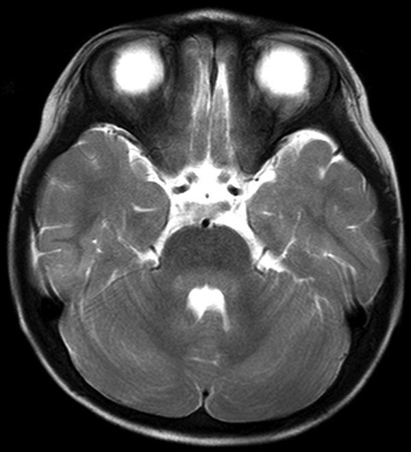 Axial T2-weighted slice of brain by magnetic resonance imaging, showing hyperintensity lesions in the pons and cerebellum around the fourth ventricle.