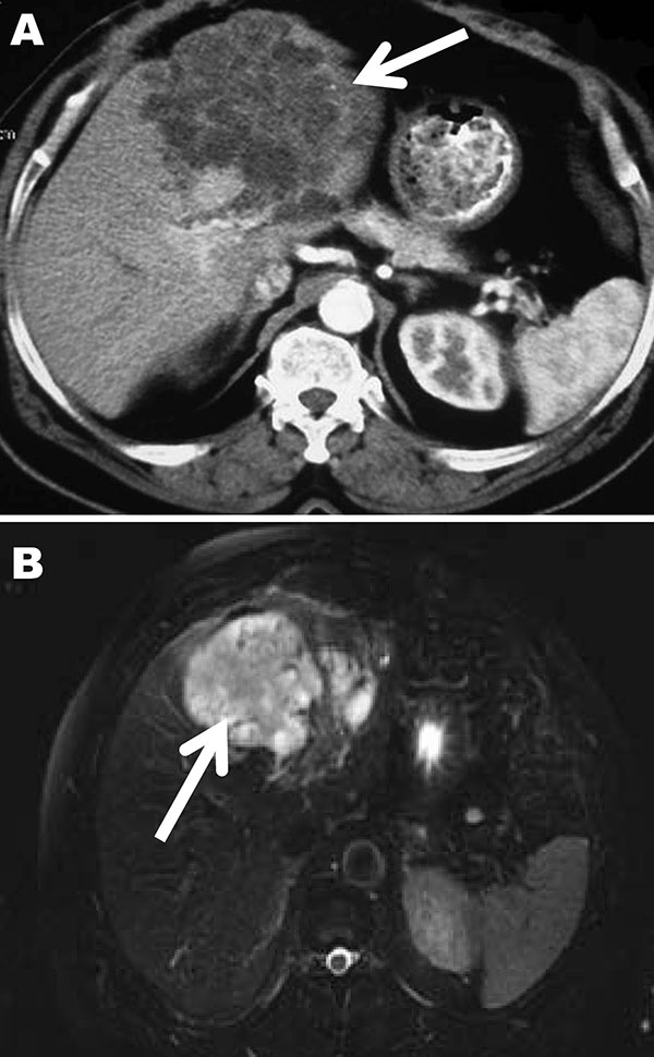 Computed tomography (A) and magnetic resonance (B) images of the liver of a 72-year-old man from French Guiana with polycystic echinococcosis affecting the left side of the liver. White arrows indicate the multicystic liver lesion.