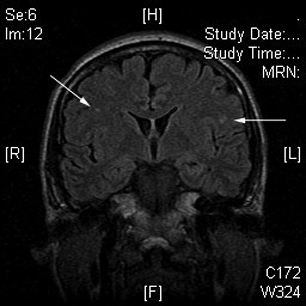 Magnetic resonance imaging of the brain of patient B, showing several nonspecific areas of enhancement (arrows), which suggests encephalitis, given the clinical scenario.