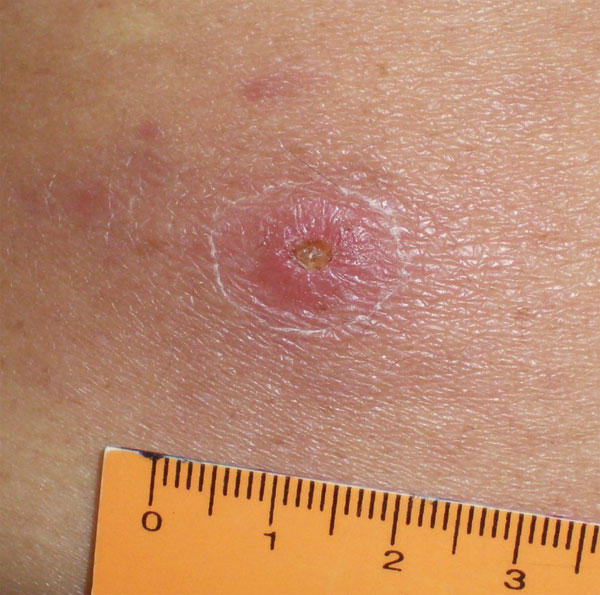 Inoculation eschar on the lumbar region of the back of a patient infected with a Rickettsia sp. from the Atlantic rainforest in the state of São Paulo, southeastern Brazil.