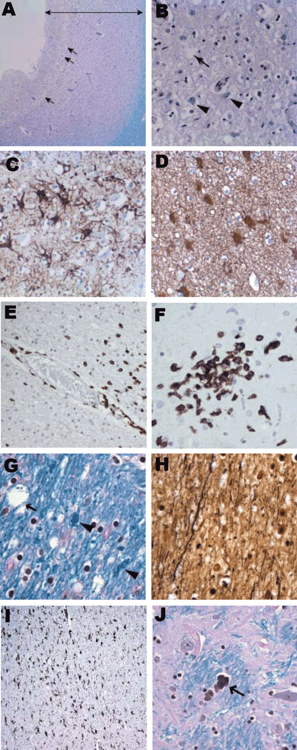 Histologic findings from brain of 15-year-old boy with X-linked agammaglobulinemia and encephalitis. A) Frontal cortex with cortical thinning (double-headed arrow) and vacuolation (arrows) (Luxol fast blue stain with periodic acid–Schiff method [LFB/PAS], original magnification ×10). B) Frontal cortex with vacuolation (arrow) and rare residual neurons (arrowheads) (LFB/PAS, original magnification ×50). C) Marked astrogliosis in the frontal cortex (glial fibrillary acidic protein [GFAP] immunosta