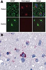 Thumbnail of Immunofluorescence and immunohistochemical analyses with human astrovirus Puget Sound capsid antibodies. A) Indirect double immunofluorescence–stained, formalin-fixed, paraffin-embedded tissue sections from 15-year-old boy with X-linked agammaglobulinemia and astrovirus encephalitis and a control with astrogliosis not caused by astrovirus infection. The sections were stained for the astrocyte marker glial fibrillary acidic protein (GFAP, green) and for viral capsid protein (rabbit s