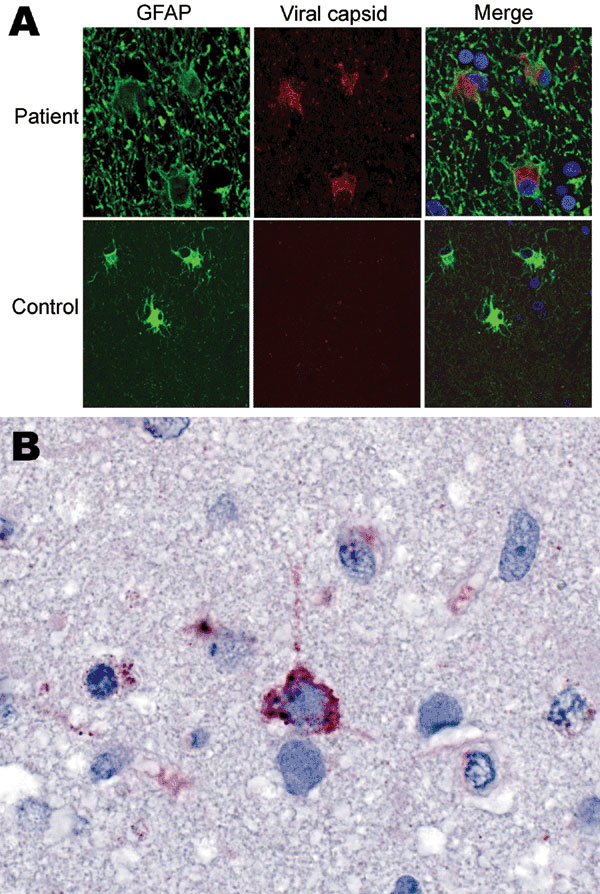 Immunofluorescence and immunohistochemical analyses with human astrovirus Puget Sound capsid antibodies. A) Indirect double immunofluorescence–stained, formalin-fixed, paraffin-embedded tissue sections from 15-year-old boy with X-linked agammaglobulinemia and astrovirus encephalitis and a control with astrogliosis not caused by astrovirus infection. The sections were stained for the astrocyte marker glial fibrillary acidic protein (GFAP, green) and for viral capsid protein (rabbit serum 1:1,000,