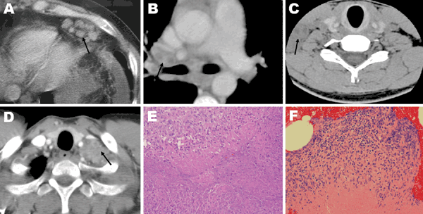Radiologic and histologic findings for patients with Granulibacter bethesdensis infections. A) Contrast-enhanced computed tomography (CT) image for patient 2, showing enlarged epigastric nodes (arrow) in the abdomen. B) Contrast-enhanced CT image for patient 3, showing lymphadenopathy (arrow). The heterogeneity of the lymph node suggests necrosis. C) Noncontrast CT image of the spine for patient 4, showing enlarged cervical lymph nodes (arrow). D) Contrast-enhanced CT image for patient 5, showin