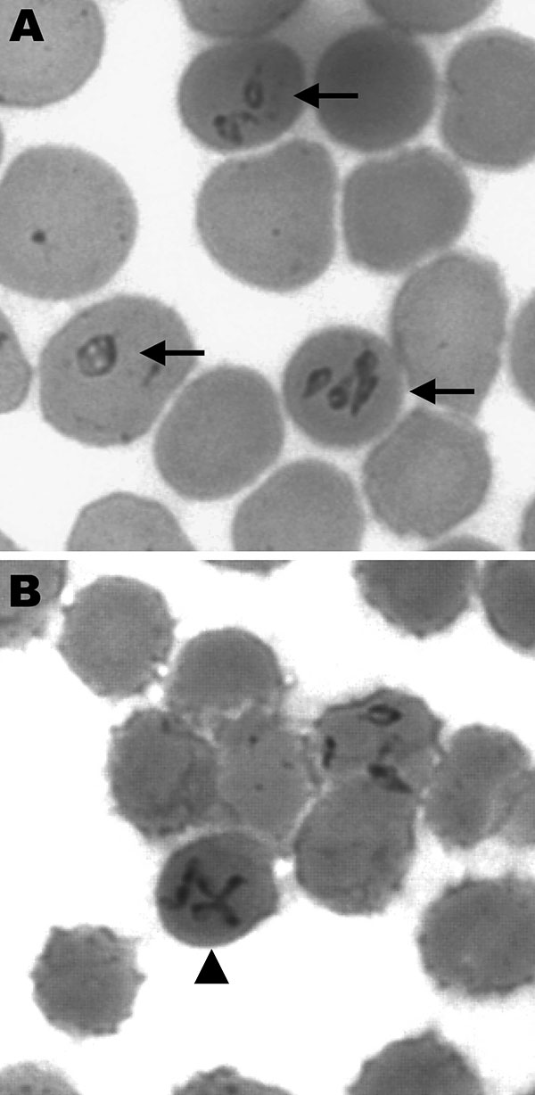 Giemsa-stained smears of peripheral blood of the patient infected with Babesia divergens, Finland, 2004. Intraerythrocytic parasites are indicated by arrows (A), and a representative Maltese cross form of the parasite is indicated by an arrowhead (B). (Original magnification ×750.)