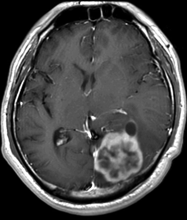 Postcontrast T1-weighted magnetic resononance image of the brain of a 44-year-old man with cerebral cryptococomma in Japan, 2007, showing a rim-enhancing lobulated mass (lower right) with surrounding edema in the left occipital lobe.
