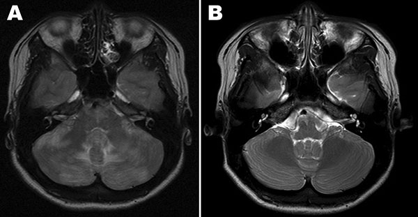 Magnetic resonance imaging (MRI) scans of case-patient’s brain. A) MRI at hospital admission shows ill-defined T2 changes in both cerebellar hemispheres, periventricular white matter, and the pons. B) MRI of the brain 1 month later, showing nearly complete disappearance of the changes observed at admission.