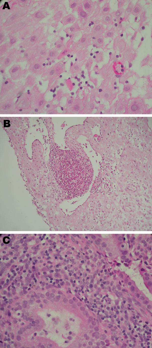 Placental histologic results (1) from 3 women with real-time PCR–positive results for Chlamydia trachomatis (Table 2). A) Case-patient 390; B) case-patient 235; C) case-patient 564. Histologic analysis shows different degree of periglandular lymphocytes infiltration, with a microabscess in B1. Original magnifications ×600 except B1 (×400).
