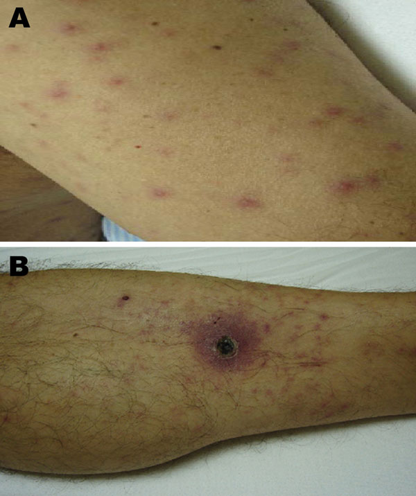 Evidence of acute infection of the skin and subcutaneous tissue in patient admitted for treatment of scrub typhus-like symptoms in Chile. A) Rash on admission, left arm. B) Necrotizing eschar with erythematous halo over the left leg.