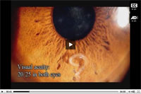 Thumbnail of Surgical removal of a Pelecitus sp. nematode from the left eye of a 29-year-old man, Brazil. A portion of the material in this video was previously published in the journal Parasites and Vectors (http://www.parasitesandvectors.com/content/pdf/1756-3305-4-41.pdf).