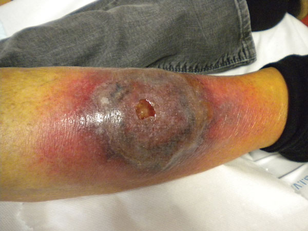 Cellulitis with a central abscess present at time of patient’s admission to hospital, Marseille, France, 2010. A color version of this figure is available online (www.cdc.gov/EID/content/17/1/145-F.htm).