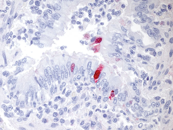 Lung section from an American badger showing immunohistochemical staining (red chromogen) specific for the pandemic (H1N1) 2009 virus within the nucleus and cytoplasm of bronchiolar epithelial cells and concurrent inflammatory cell infiltrates; hematoxylin counterstain. Original magnification ×158.