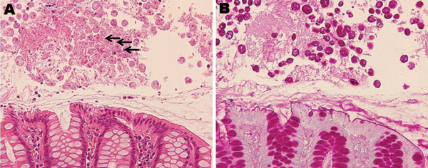 Histologic analysis of amebic colitis, Japan, 2003–2009. A) Trophozoites of Entamoeba histolytica ingesting erythrocytes (arrows) (hematoxylin and eosin stain). B) Numerous amebic trophozoites on the mucosal surface (periodic acid–Schiff stain). Original magnification ×200.