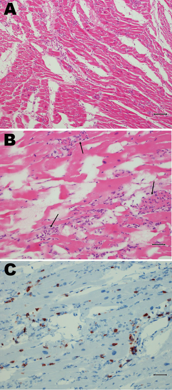 Postmortem tissue sections from chimpanzee with coxsackie virus B infection, Denmark. A) Myocardial section showing artifacts of freezing and a diffuse lymphocytic infiltration. Scale bar = 80 µm. B) Myocytic degeneration (arrows) is evident. Scale bar = 40 µm. C) CD3 marker reaction showing T lymphocytes. Scale bar = 40 µm.