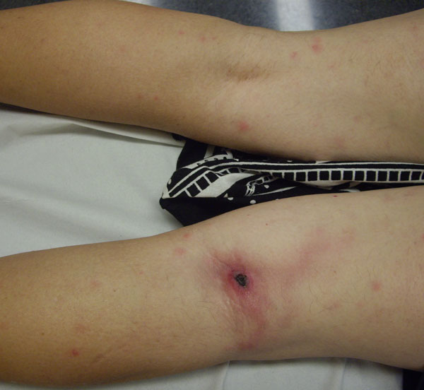 Inoculation eschar on popliteal area and discrete maculopapular elements in patient with lymphangitis infected with Rickettsia sibirica mongolitimonae, Spain, 2011. 