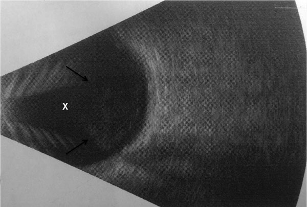 Ocular ultrasound demonstrating hyperechoic, punctate opacities (arrows) within the vitreous chamber (X) of a patient with coccidioidomycosis, California, USA.