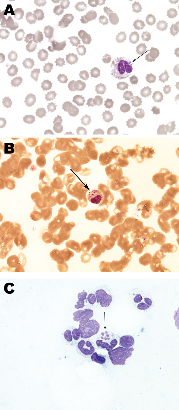 Histopathology slides from 36-year-old woman with human granulocytic anaplasmosis, Slovenia, 2010. Peripheral blood smear (A, B); bone marrow smear (C). Modified Giemsa staining, original magnification ×1,000. Morulae (clusters of Anaplasma phagocytophilum in granulocytic leukocytes) are indicated by arrows. In Europe, morulae have been reported in only 1 patient (6), but they are a relatively common observation in the United States, associated predominately with severe cases of human granulocyt