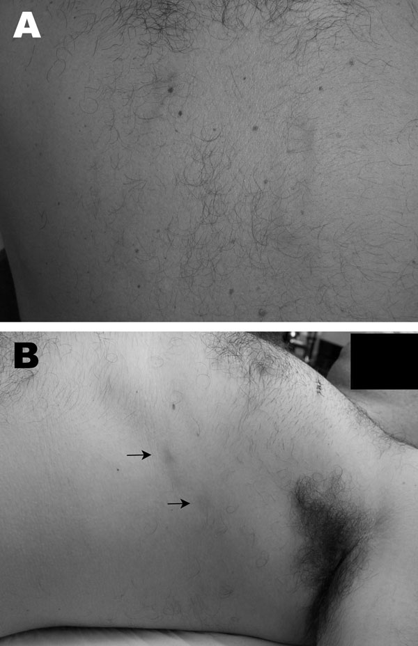 Gnathostomiasis in a 37-year-old man, Brazil. A) Evanescent winding, linear, reddish lesions on the back in 2005. B) Deep migratory reddish nodules (arrows) on the lateral thorax, occurring in 2009 after treatment with albendazol for helmintic prophylaxis.