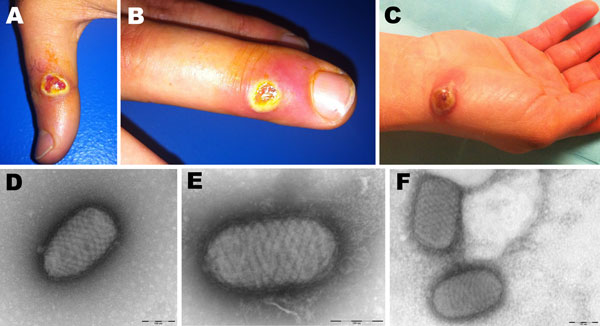 Orf virus infection in 5 persons who butchered or prepared lambs as part of a religious practice for Eid al-Adha (the Muslim Feast of Sacrifice), Marseille, France, 2011. Cutaneous lesions on hands of case-patient 3 (A, B) and case-patient 5 (C) are shown. Negative-staining electron microscopy of samples from case-patient 3 (D) and case-patient 5 (E, F) show ovoid particles (≈250 nm long, 150 nm wide) with a crisscross appearance; the size and appearance of these particles are highly suggestive 