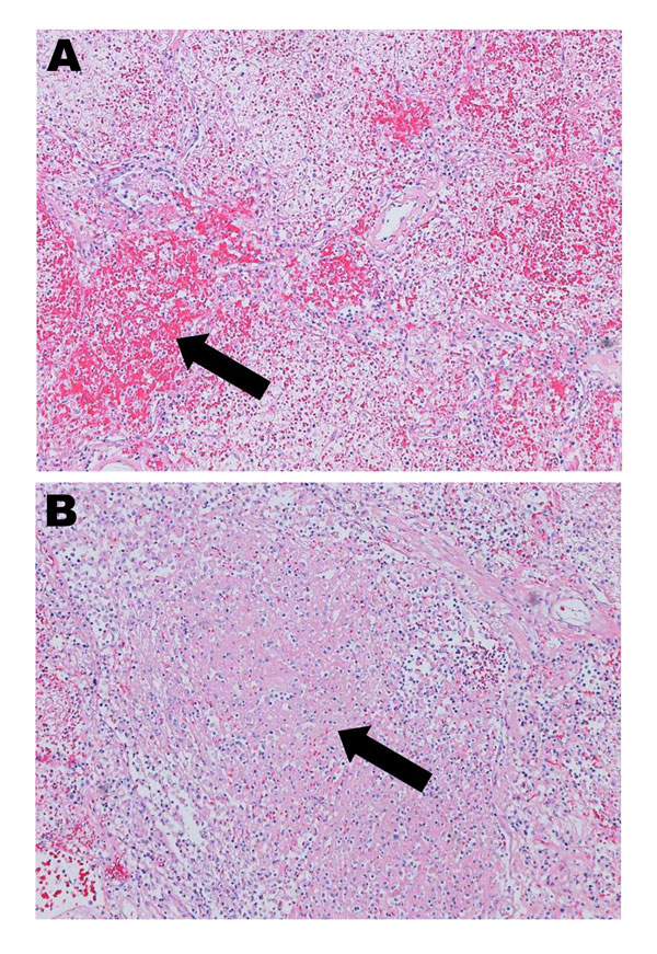 Hematoxylin and eosin–stained lung tissue (original magnification ×10) from a patient in New Brunswick, Canada, with a fatal case of pneumonia caused by adenovirus 14. A) Arrow shows a patchy area of hemorrhagic consolidation. B) Arrow shows an area of necrosis.