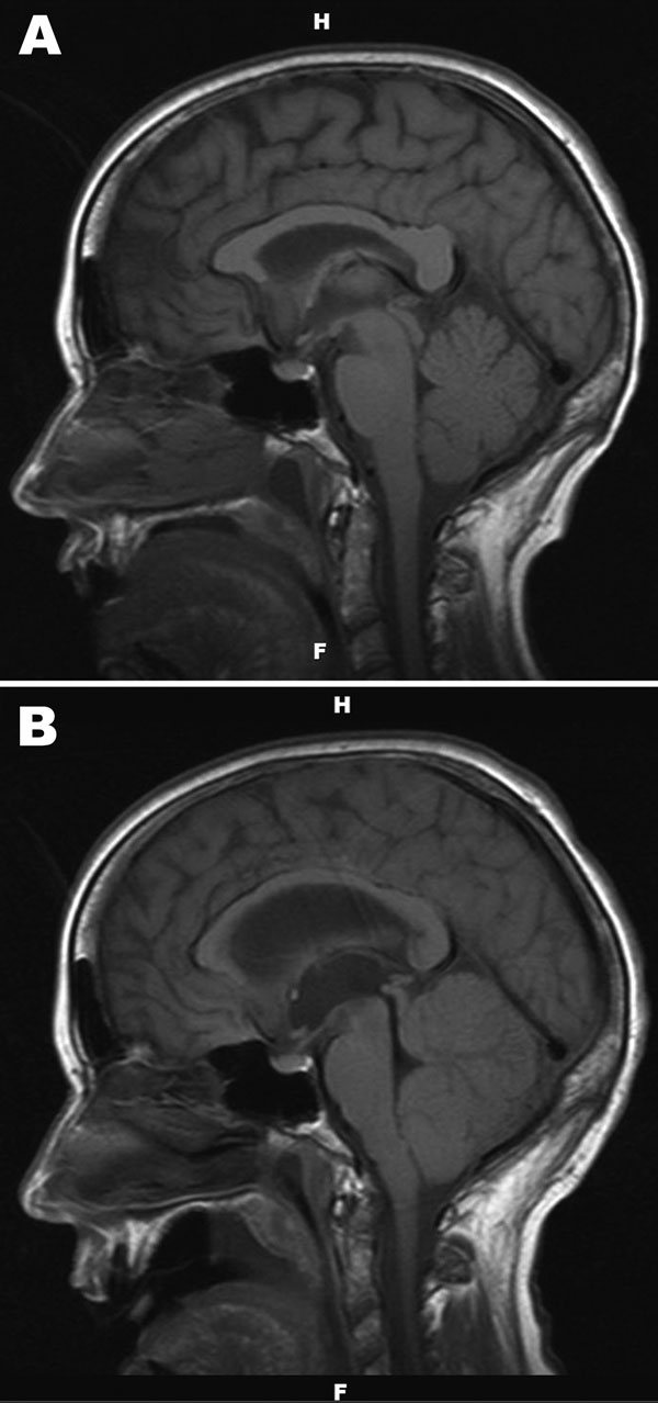 A) Noncontrast, sagittal T1-weighted magnetic resonance image of the brain of a 67-year-old woman with suspected Powassan virus encephalitis, obtained 4 days after admission. Image is notable for nonspecific signal changes within the thalami, midbrain, cerebellar vermis, and both cerebellar hemispheres. B) Noncontrast, sagittal T1-weighted magnetic resonance image of the brain obtained 8 days after patient’s admission. Changes include marked interval progression of signal abnormality involving t