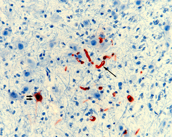 Nipah virus (NiV) antigen in neuron (double arrows) and capillary endothelia (single arrow) of a ferret experimentally infected with NiV-Bangladesh. Rabbit α-NiV N protein antiserum. Original magnification ×200. 