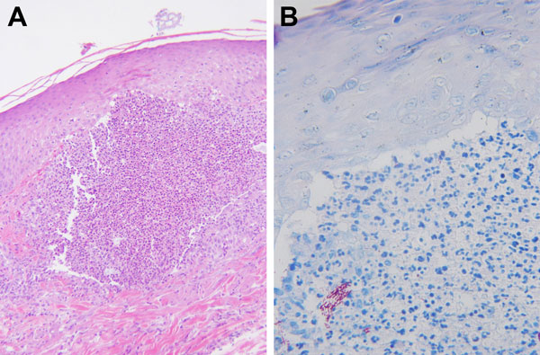 Skin biopsy specimens of a 53-year-old woman (case-patient 1) after fractionated CO2 laser resurfacing. A) Hematoxylin and eosin–stained and B) Ziehl-Neelsen acid-fast–stained sections show a tiny superficial microabscess surrounded by sparse granulomatous inflammation. Several groups of acid-fast organisms can be seen at the lower left of panel B. Original magnifications: 400× in A and 600× in B. 