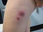 Thumbnail of Mycobacterium chelonae abscesses associated with biomesotherapy, an alternative therapy practice, Adelaide, South Australia, Australia, 2008. The abscesses are at the biomesotherapy injection site. (Photo courtesy of Erina Gray.)