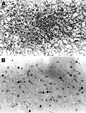 Liver tissue from Chacma baboon 9732, South Africa, showing lobular hepatitis. Liver tissue was obtained at necropsy, fixed in formalin, embedded in paraffin, and sectioned. A) Hematoxylin and eosin staining, showing a focus of mild lobular hepatitis but no evidence of interface hepatitis or bridging necrosis. Portal tracts are normal. B) Immunoperoxidase staining with polyclonal antibody against hepatitis B core antigen. Core antigen was detected in the occasional hepatocyte nucleus. Arrows ind