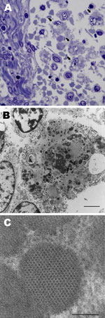 Thumbnail of Lymph node from sentinel dog from which dog circovirus was identified. A) Toluidine blue stain shows multiple macrophages within the medullary sinus contain vacuoles and discrete, oblong to round, variably stained cytoplasmic bodies (arrows). B) A single macrophage adjacent to a lymphocyte (upper left) and partial profiles of other cells. Intracytoplasmic inclusion bodies are distributed throughout the macrophage cytoplasm, along with mitochondria and vacuoles. Scale barA indicates 