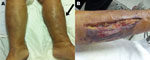 Thumbnail of Shewanella haliotis severe soft tissue infection of woman in Thailand, 2012. The patient sought treatment for painful erythematous swelling of the left leg. A) Arrow indicates affected area. B) Postsurgical fasciotomy wound with necrotic tissue.