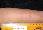 Thumbnail of Clinical presentation of verruga peruana in 3-year-old boy, Peru, 2003.