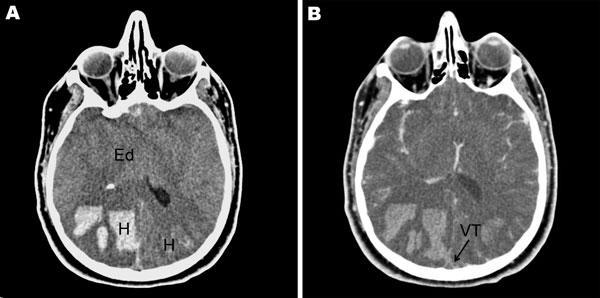 A) Noncontrast cranial computed tomographic (CT) scan of a 26-year-old immunocompetent man with influenza, showing diffuse cerebral edema (Ed) and bilateral parieto-occipital hematoma (H). B) Cranial CT scan with contrast injection, showing diffuse cerebral edema (Ed) and cord sign (arrow) related to a venous thrombosis (VT) of the superior sagittal sinus.